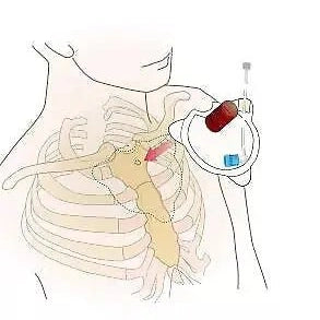 FAST1 Intraosseous Infusion System– MED-TAC International Corp.