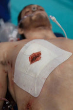 Russell Chest Seal - Safeguard Medical
