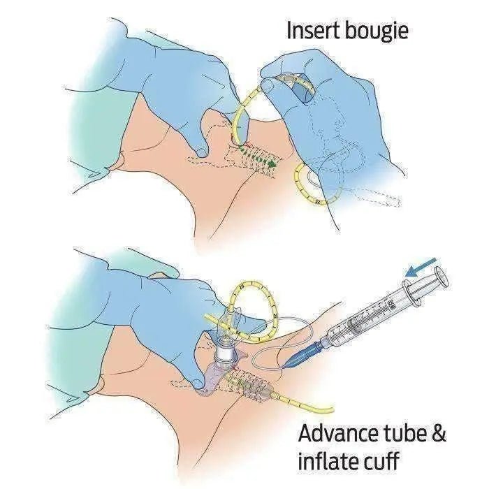 Bougie - Aided Cricothyroidotomy Pack (BAC - Pack™) - North American Rescue