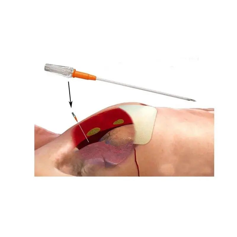 MTI Chest Decompression Needle - MED - TAC International