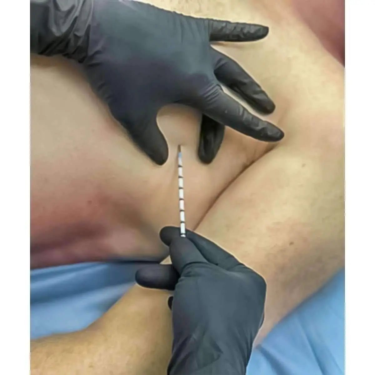 SPEAR - Simplified Pneumothorax Emergency Air Release) Device - North American Rescue